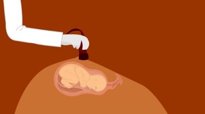 Will oligohydramnios(low amniotic fluid) cause problems in pregnancy?