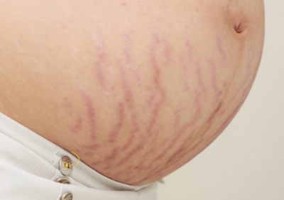 Stretch Marks Creams during pregnancy