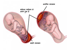 क्या हमें दूसरी तिमाही के दौरान रक्तस्राव के बारे में चिंतित होना चाहिए?