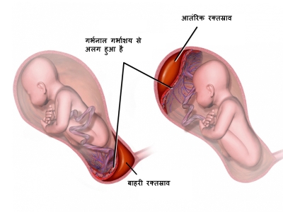 क्या हमें दूसरी तिमाही के दौरान रक्तस्राव के बारे में चिंतित होना चाहिए?