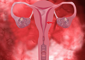 Heavy menstrual bleeding