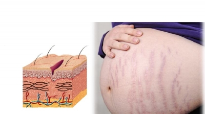 Stretch marks during pregnancy