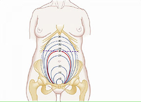 गर्भकालीन उम्र के लिए कम वजन  (बच्चे का कम वजन) (Small for Gestation)