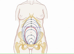 गर्भकालीन उम्र के लिए कम वजन  (बच्चे का कम वजन) (Small for Gestation)