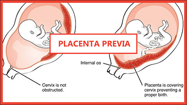 Placenta Previa