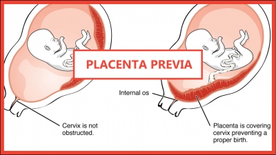 Placenta Previa