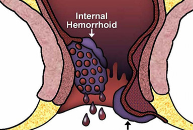 ಗರ್ಭಾವಸ್ಥೆಯಲ್ಲಿ ಹೆಮೊರೊಯಿಡ್ಸ್/ಮೂಲವ್ಯಾಧಿ (Hemorrhoids during pregnancy)