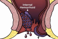 ಗರ್ಭಾವಸ್ಥೆಯಲ್ಲಿ ಹೆಮೊರೊಯಿಡ್ಸ್/ಮೂಲವ್ಯಾಧಿ (Hemorrhoids during pregnancy)