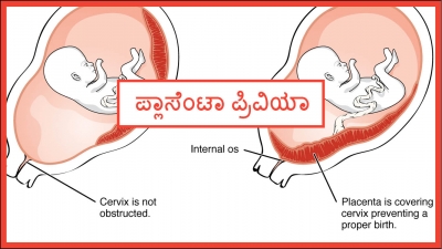 ಪ್ಲಾಸೆಂಟಾ ಪ್ರಿವಿಯಾ